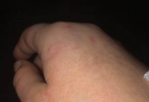 Agresywny pies pogryzł 13-latkę i jej pieska w Zielonej Górze. Dziecku grożą bolesne zastrzyki. Matka szuka właściciela psa (ZDJĘCIA)