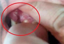 Pijana dentystka w Zielonej Górze zostawiła pacjentowi kawałek usuwanego zęba